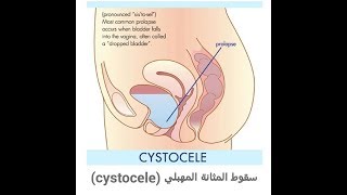 اسباب هبوط المثانة على المهبل د.محمد جادCYSTOCELE   DRJAAD