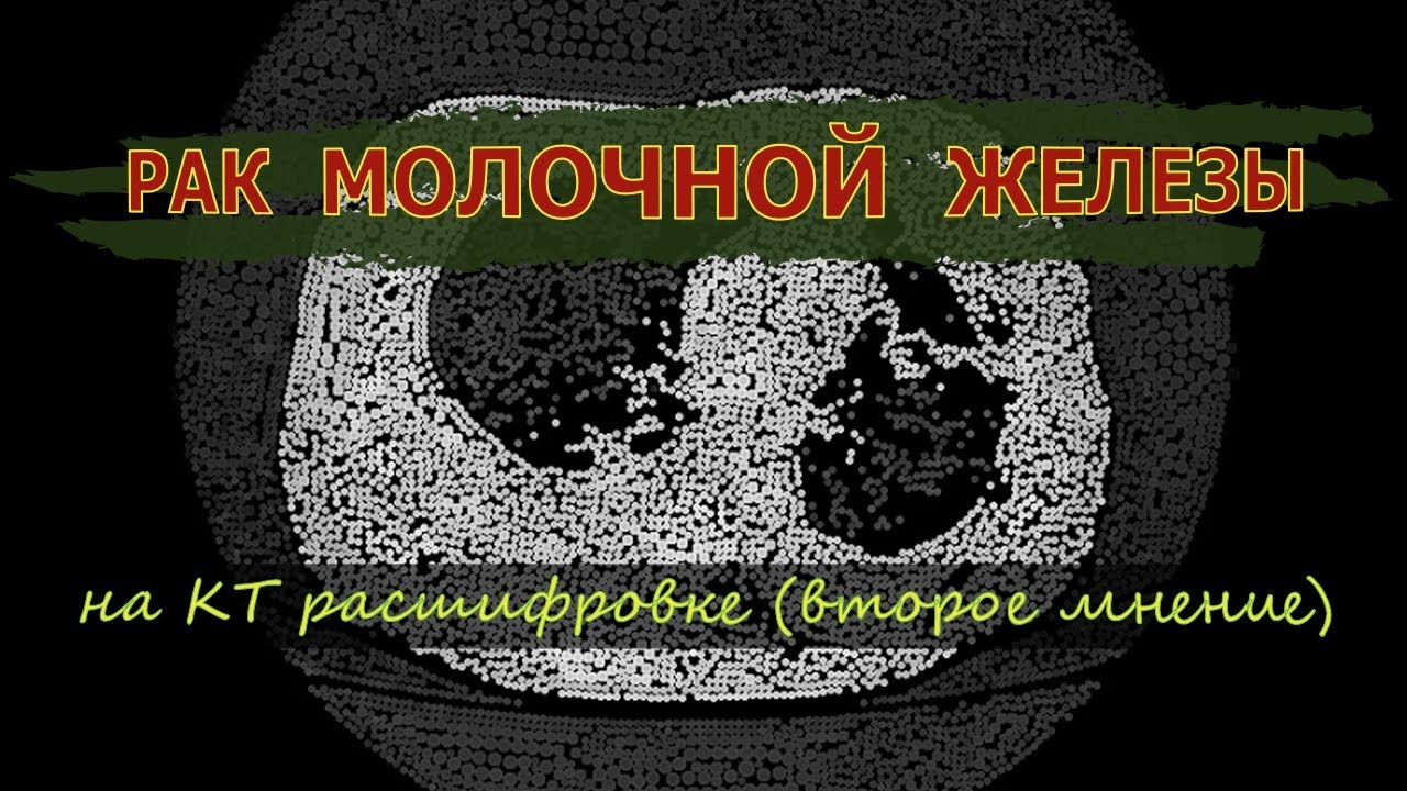 РАК МОЛОЧНОЙ ЖЕЛЕЗЫ с метастазами и ГИДРОТОРАКС легких на расшифровке ...