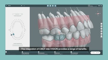 CBCT Scan | CBCT in VISION