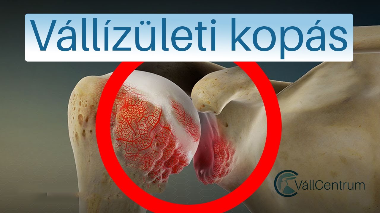 Ízületi hialuronsav injekció - FájdalomKözpont - Kenések kenésekhez és ízületekhez