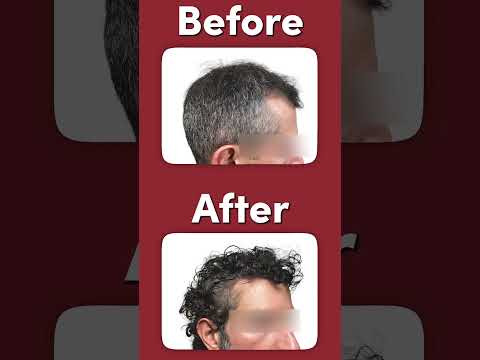 2,900 FUE grafts