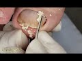 MUITA MACERAÇÃO EMBAIXO DA UNHA #ingrowntoenail #nails