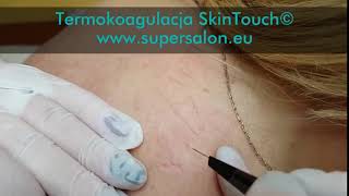 Helen Springs - Termokoagulacja Skintouch