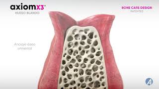 Bone is Gold - Implante dental Axiom X3®