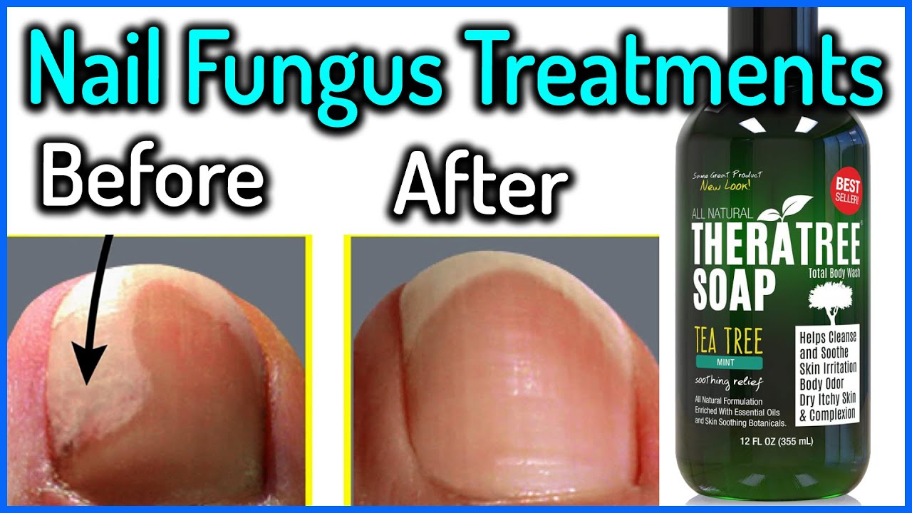 Anti-Fungal Nail Treatments | Walgreens