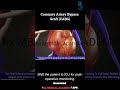🫀 CABG in 60 Seconds!