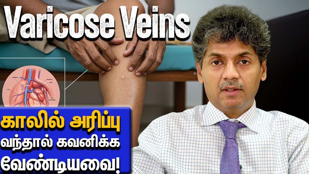 Varicose Veins – காலில் அரிப்பு வந்தால் கவனிக்க வேண்டியவை! | Dr Bala Kumar