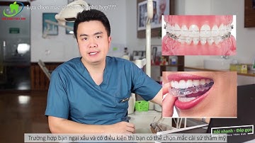 Bí Quyết - Lựa chọn loại mắc cài niềng răng sao cho phù hợp - Hỏi nhanh Đáp gọn!