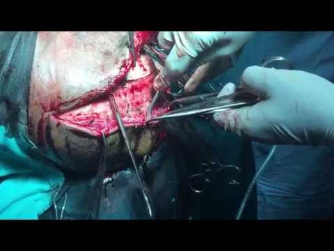 cranioplasty