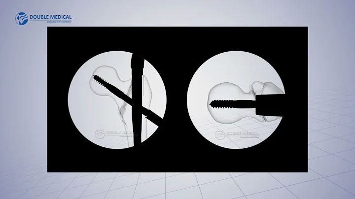 APFN Lag Screw Insertion