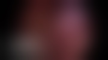 tubeless non intubated uniportal VATS wedge resection