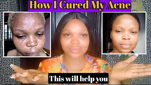 How I got rid of my acne, Scars, Hyperpigmentation