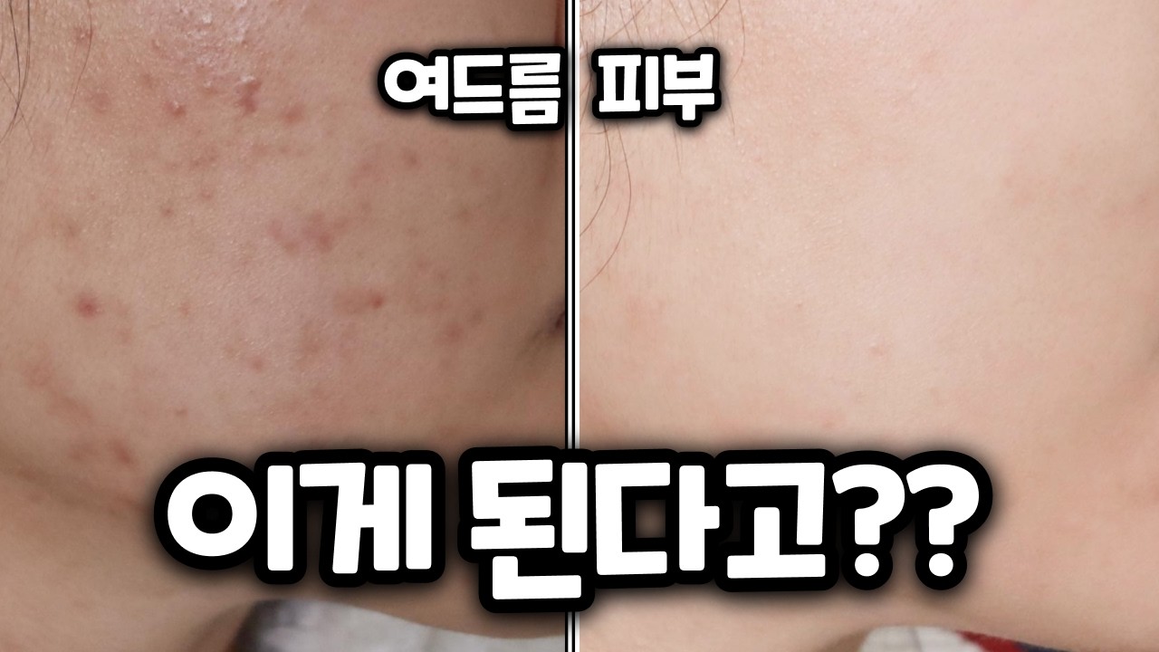 여드름 피부 케어에 직접 효과본 5가지 성분! 그냥..이거 사세요!!