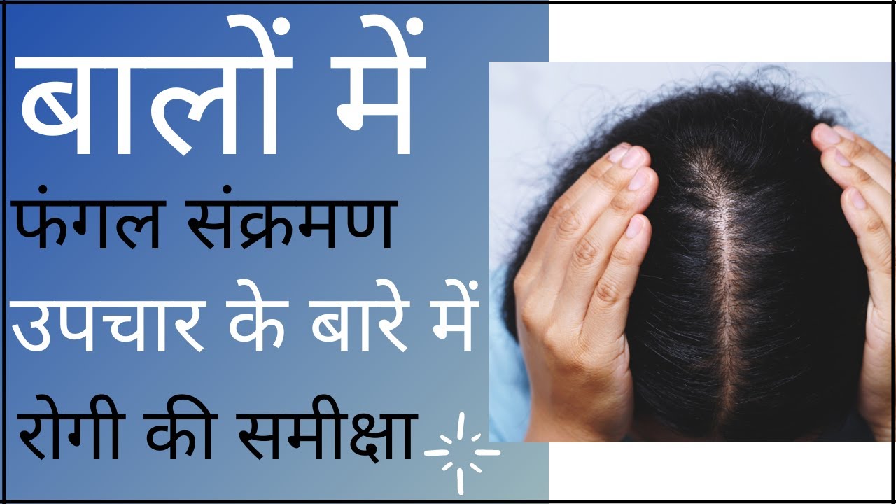 Hair Fungal Infection Treatment Hair Fungal Infection Itchy Scalp