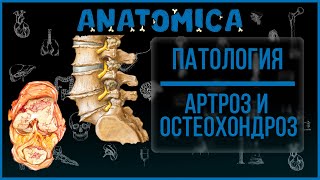 Артроз, остеоартроз, остеоартрит - патогенез и проявления / Патология