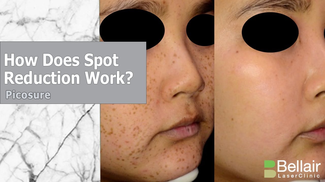 How does Picosure brown spot removal work? YouTube