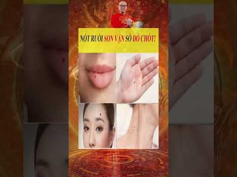 Nốt Ruồi Son