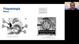 Femoroacetabular Impingement