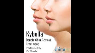 Kybella Double Chin Removal Treatment By Dr Shukla l ShineMD MedSpa Liposuction Center