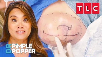 All the Pops from Season 9 Part 1 | Dr. Pimple Popper | TLC