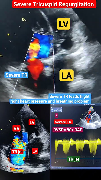 Severe TR Echo l RVSP l Tricuspid Regurgitation #echo #shorts