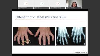3/12/2021: How Not to Get Rheumatoid Arthritis screenshot 2