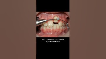 Braces can change your smile!!! #braces #orthodontist #dentist #smilemakeover