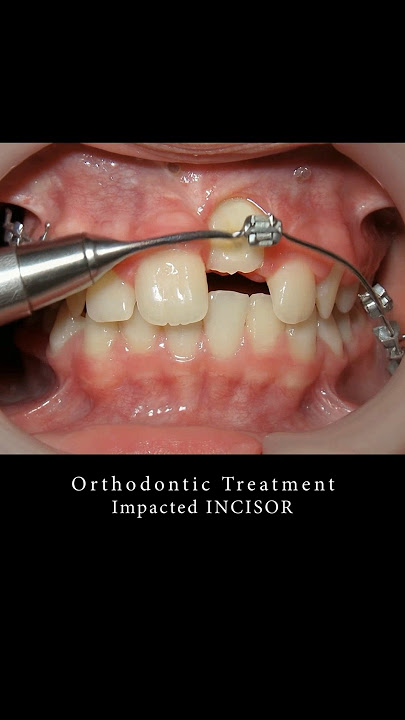 Braces can change your smile!!! #braces #orthodontist #dentist #smilemakeover