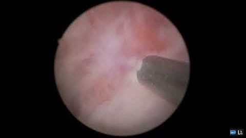HoLEP for Recurrent Obstruction post Rezum