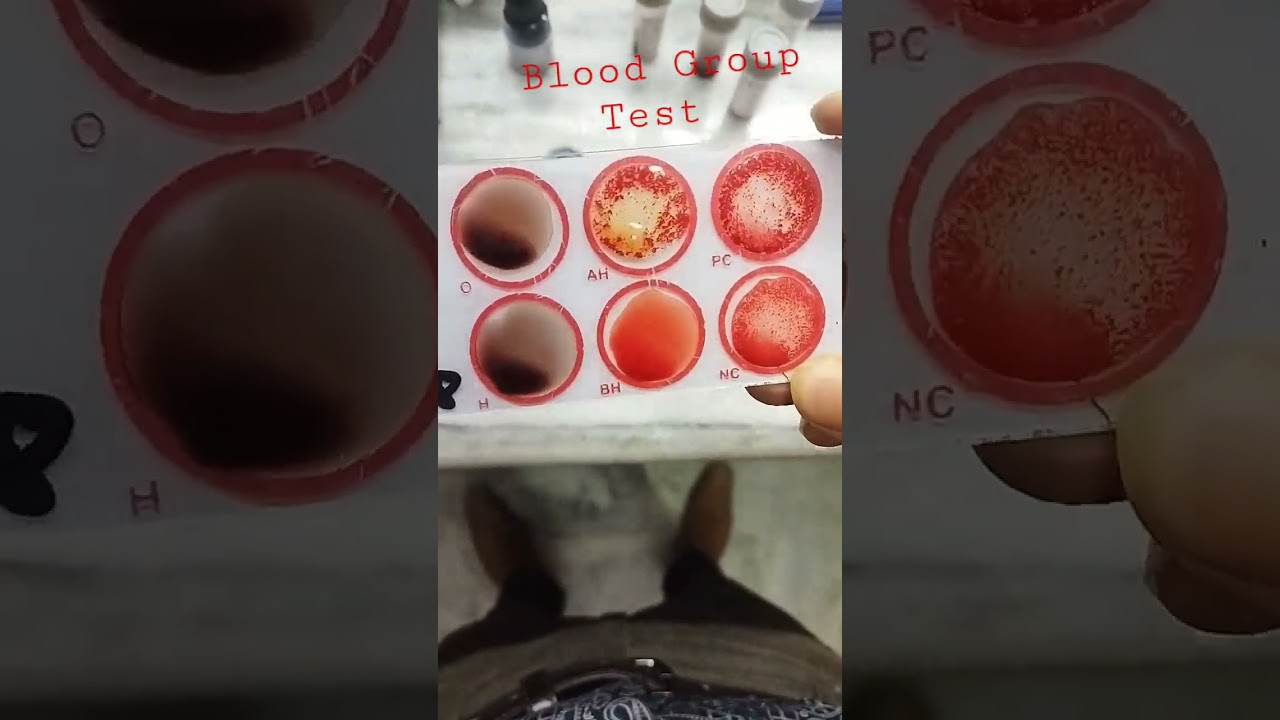 Blood Group Test 