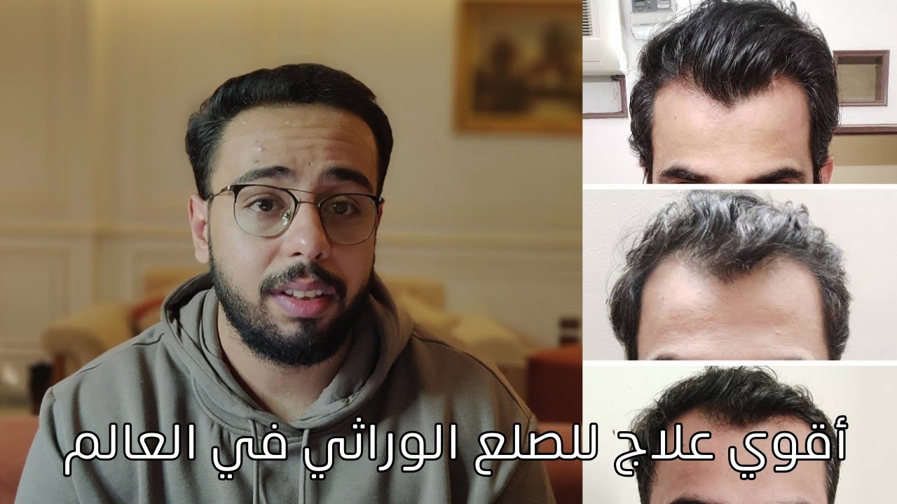 الدوتاسترايد ٢.٥ مجم أقوي علاج للصلع الوراثي حتي الأن !