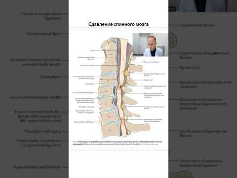 Сдавление спинного мозга - что происходит внутри позвоночника? #грыжапозвоночника