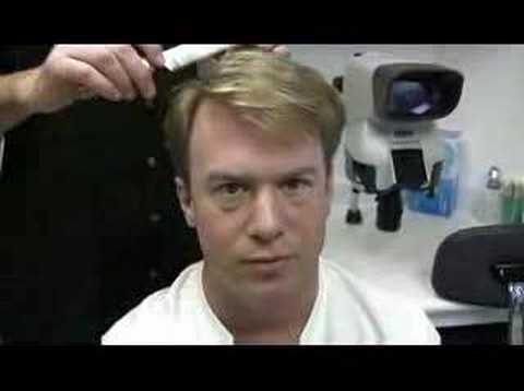 Bobman - Hair Transplant 2 Results - Hasson & Wong