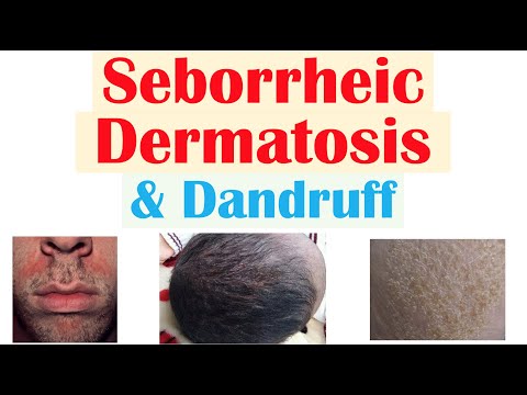 Seborrheic Dermatitis (Dandruff and Cradle Cap) Causes, Risk Factors, Symptoms, Diagnosis, Treatment