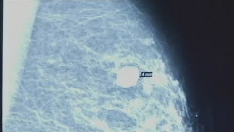 FDA approves AI breakthrough designed to predict breast cancer risk up to 5 years in advance