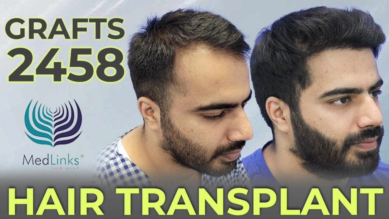 Perfect-i Hair Transplant in Advance Baldness India| Grade 7 Baldness| 5800  Grafts in 2 Sessions - YouTube