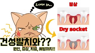 드라이소켓!! 꼭 피하세요!!