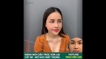 ĐẸP HẾT NẤC VỚI KẾT QUẢ NÂNG MŨI CẮT MÍ VỪA TRÒN 10 NGÀY