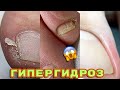 Гипергидроз стоп 😟 Год без педикюра / Влажные ножки / Педикюр