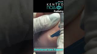 Corn Removal #foot #orthotics #κεντροποδιου #κεντροποδιου #πόδια #calluses #feet #footpain #athlete