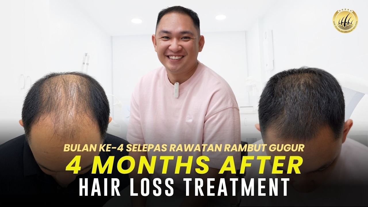 Hair Transplant Malaysia | 4 Months Hair Loss Treatment Results | Stage 6 Male Pattern Hair Loss