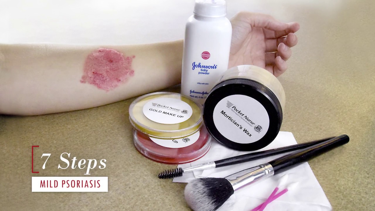 Psoriasis Moulage How-To