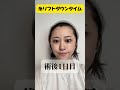 【40歳糸リフト受けてきた】直後から腫れはほとんどないし、内出血もほぼなし!糸リフトならBRIGHTS beauty clinicのドクター今村にお任せ✨#short #たるみ治療 #美容
