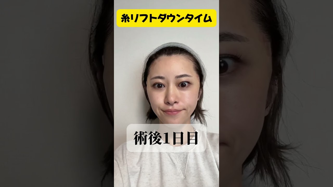 【40歳糸リフト受けてきた】直後から腫れはほとんどないし、内出血もほぼなし!糸リフトならBRIGHTS beauty clinicのドクター今村にお任せ✨#short #たるみ治療 #美容