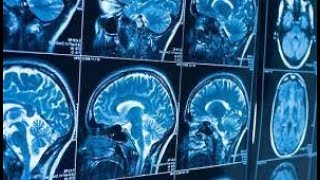 Comparative Analysis of Automatic Brain Tumor Segmentation Techniques Using Watershed, Region