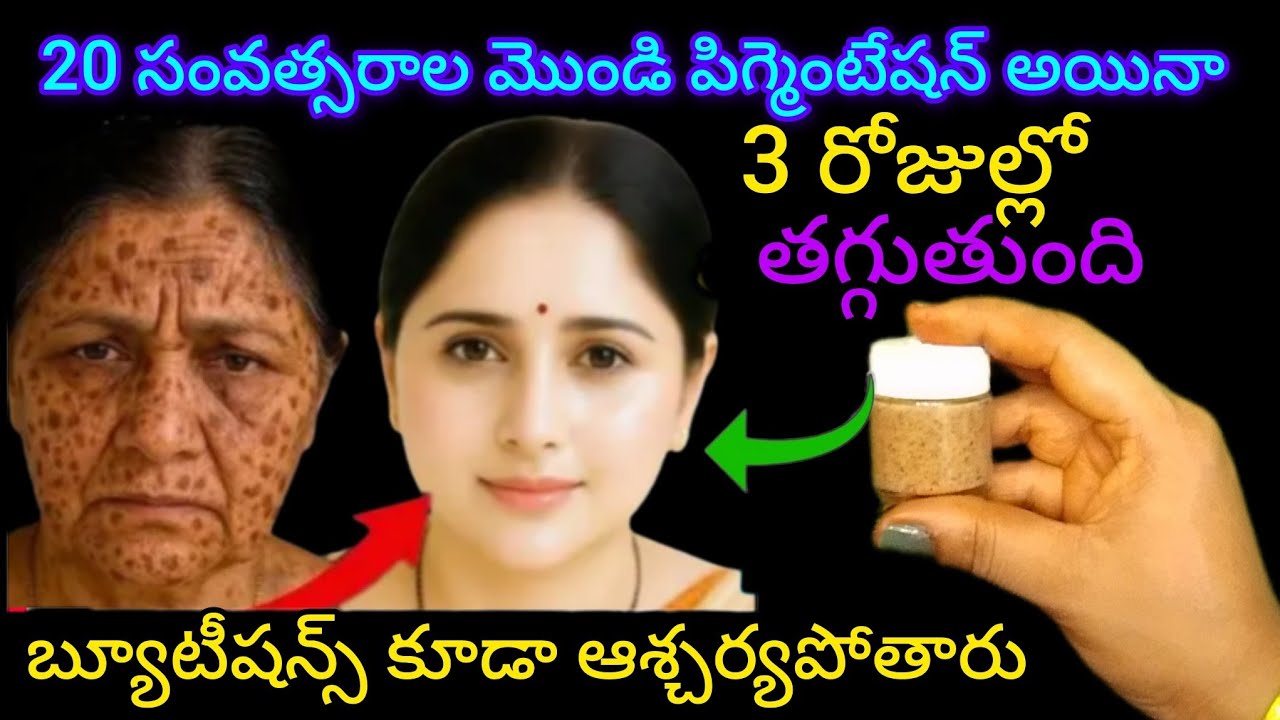 20 సంవత్సరాల నుండి ఉన్న మంగు మచ్చలు 3 రోజుల్లో తగ్గుతుంది #పిగ్మెంటేషన్ పోవడానికి ఇంటి చిట్కాలు 