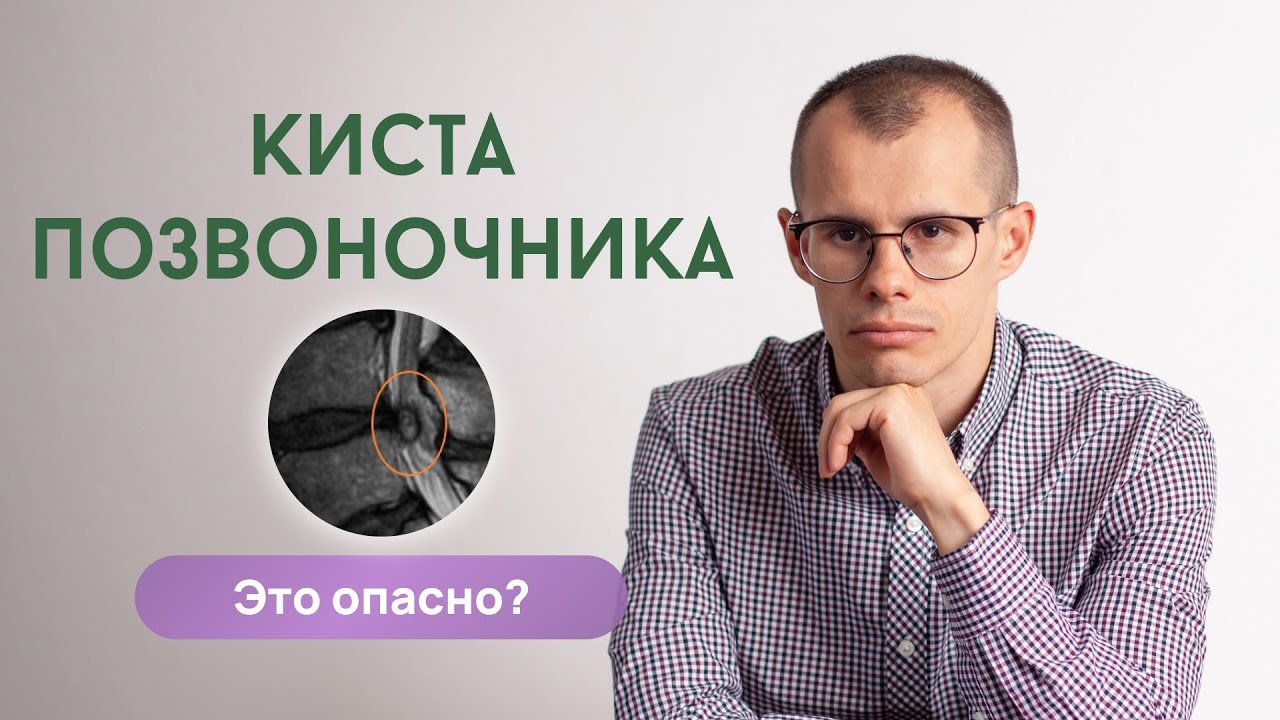 Киста позвоночника. Параартикулярная киста. Это опасно?