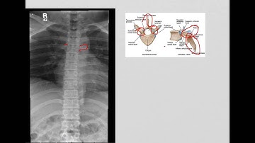 Thoracic Spine AP and Lateral