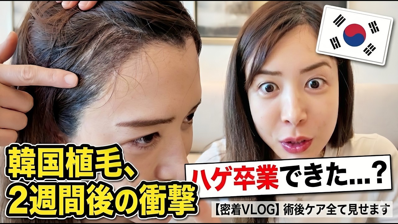 【ハゲ植毛】韓国植毛から2週間。生え際のリアルな経過とダウンタイムの過ごし方全て見せます。#hairtransformation