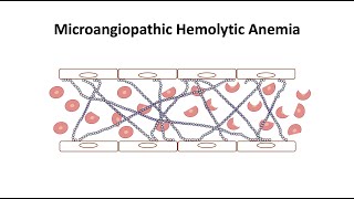 Microangiopathic Hemolytic Anemia